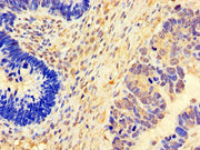 Immunohistochemistry of paraffin-embedded human ovarian cancer using CSB-PA008637LA01HU at dilution of 1:100