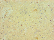 Immunohistochemistry of paraffin-embedded human glioma using CSB-PA008638ESR1HU at dilution of 1:100