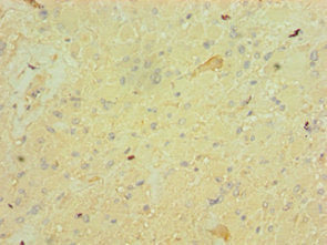 Immunohistochemistry of paraffin-embedded human glioma using CSB-PA008638ESR1HU at dilution of 1:100