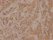 IHC image of CSB-PA008645LA01HU diluted at 1:100 and staining in paraffin-embedded human liver cancer performed on a Leica BondTM system. After dewaxing and hydration, antigen retrieval was mediated by high pressure in a citrate buffer (pH 6.0). S...