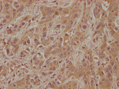 IHC image of CSB-PA008645LA01HU diluted at 1:100 and staining in paraffin-embedded human liver cancer performed on a Leica BondTM system. After dewaxing and hydration, antigen retrieval was mediated by high pressure in a citrate buffer (pH 6.0). S...