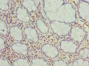 Immunohistochemistry of paraffin-embedded human colon cancer using CSB-PA008746ESR2HU at dilution of 1:100