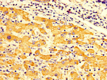 IHC image of CSB-PA008749LA01HU diluted at 1:300 and staining in paraffin-embedded human liver cancer performed on a Leica BondTM system. After dewaxing and hydration, antigen retrieval was mediated by high pressure in a citrate buffer (pH 6.0). S...