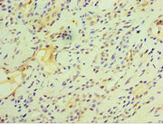 Immunohistochemistry of paraffin-embedded human breast cancer using CSB-PA008793ESR1HU at dilution of 1:100