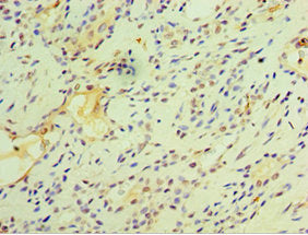Immunohistochemistry of paraffin-embedded human breast cancer using CSB-PA008793ESR1HU at dilution of 1:100