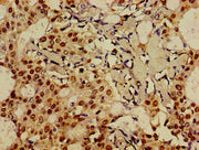 Immunohistochemistry of paraffin-embedded human breast cancer using CSB-PA008794LA01HU at dilution of 1:100