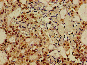 Immunohistochemistry of paraffin-embedded human breast cancer using CSB-PA008794LA01HU at dilution of 1:100
