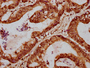 IHC image of CSB-PA008796LA01HU diluted at 1:700 and staining in paraffin-embedded human colon cancer performed on a Leica BondTM system. After dewaxing and hydration, antigen retrieval was mediated by high pressure in a citrate buffer (pH 6.0). S...