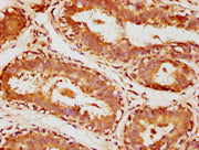 IHC image of CSB-PA00887A0Rb diluted at 1:1000 and staining in paraffin-embedded human breast cancer performed on a Leica BondTM system. After dewaxing and hydration, antigen retrieval was mediated by high pressure in a citrate buffer (pH 6.0). Se...