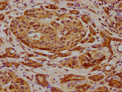 IHC image of CSB-PA009007LA01HU diluted at 1:600 and staining in paraffin-embedded human pancreatic cancer performed on a Leica BondTM system. After dewaxing and hydration, antigen retrieval was mediated by high pressure in a citrate buffer (pH 6....