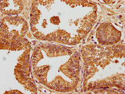 IHC image of CSB-PA009018PA01HU diluted at 1:100 and staining in paraffin-embedded human prostate cancer performed on a Leica BondTM system. After dewaxing and hydration, antigen retrieval was mediated by high pressure in a citrate buffer (pH 6.0)...