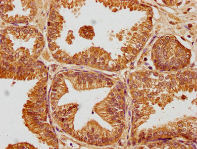 IHC image of CSB-PA009018PA01HU diluted at 1:100 and staining in paraffin-embedded human prostate cancer performed on a Leica BondTM system. After dewaxing and hydration, antigen retrieval was mediated by high pressure in a citrate buffer (pH 6.0)...