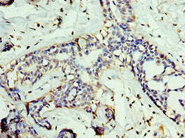 Immunohistochemistry of paraffin-embedded human breast cancer using CSB-PA009228ESR2HU at dilution of 1:100