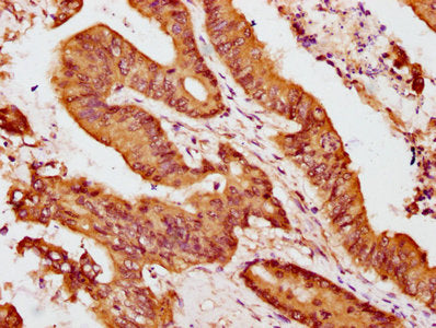IHC image of CSB-PA009321LA01HU diluted at 1:100 and staining in paraffin-embedded human colon cancer performed on a Leica BondTM system. After dewaxing and hydration, antigen retrieval was mediated by high pressure in a citrate buffer (pH 6.0). S...