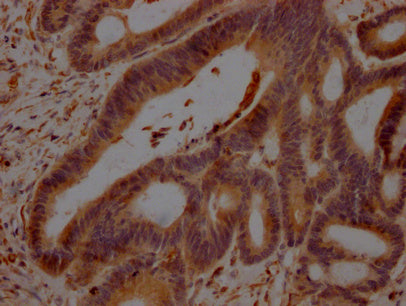 IHC image of CSB-PA009344LA01HU diluted at 1:100 and staining in paraffin-embedded human colon cancer performed on a Leica BondTM system. After dewaxing and hydration, antigen retrieval was mediated by high pressure in a citrate buffer (pH 6.0). S...