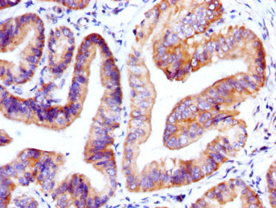 IHC image of CSB-PA009352EA01HU diluted at 1:400 and staining in paraffin-embedded human endometrial cancer performed on a Leica BondTM system. After dewaxing and hydration, antigen retrieval was mediated by high pressure in a citrate buffer (pH 6...