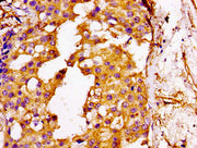 IHC image of CSB-PA009388LA01HU diluted at 1:100 and staining in paraffin-embedded human breast cancer performed on a Leica BondTM system. After dewaxing and hydration, antigen retrieval was mediated by high pressure in a citrate buffer (pH 6.0)....