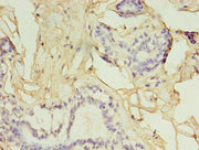 Immunohistochemistry of paraffin-embedded human breast cancer using CSB-PA009393HA01HU at dilution of 1:100