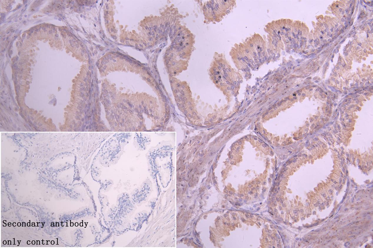 IHC image of CSB-PA822219LA01HU diluted at 1:20 and staining in paraffin-embedded human prostate cancer performed on a Leica BondTM system. After dewaxing and hydration, antigen retrieval was mediated by high pressure in a citrate buffer (pH 6.0)....