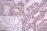 IHC image of CSB-PA822219LA01HU diluted at 1:20 and staining in paraffin-embedded human prostate cancer performed on a Leica BondTM system. After dewaxing and hydration, antigen retrieval was mediated by high pressure in a citrate buffer (pH 6.0)....