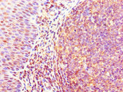 Immunohistochemistry of paraffin-embedded human tonsil tissue using CSB-PA009443ESR2HU at dilution of 1:100