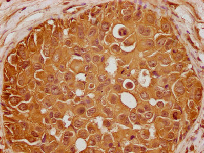 IHC image of CSB-PA009500OA01HU diluted at 1:100 and staining in paraffin-embedded human breast cancer performed on a Leica BondTM system. After dewaxing and hydration, antigen retrieval was mediated by high pressure in a citrate buffer (pH 6.0)....