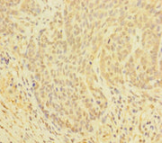 Immunohistochemistry of paraffin-embedded human ovarian cancer using CSB-PA009521EA01HU at dilution of 1:100