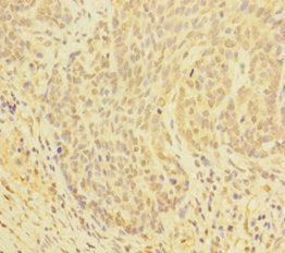 Immunohistochemistry of paraffin-embedded human ovarian cancer using CSB-PA009521EA01HU at dilution of 1:100