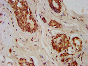 IHC image of CSB-PA009569LA01HU diluted at 1:400 and staining in paraffin-embedded human breast cancer performed on a Leica BondTM system. After dewaxing and hydration, antigen retrieval was mediated by high pressure in a citrate buffer (pH 6.0)....