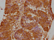 IHC image of CSB-PA009600LA01HU diluted at 1:500 and staining in paraffin-embedded human colon cancer performed on a Leica BondTM system. After dewaxing and hydration, antigen retrieval was mediated by high pressure in a citrate buffer (pH 6.0). S...