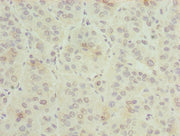 Immunohistochemistry of paraffin-embedded human liver cancer using CSB-PA009617LA01HU at dilution of 1:100