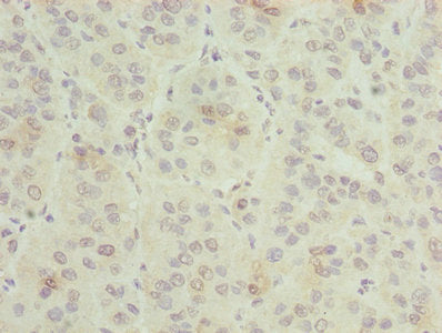 Immunohistochemistry of paraffin-embedded human liver cancer using CSB-PA009617LA01HU at dilution of 1:100