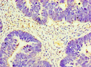 Immunohistochemistry of paraffin-embedded human ovarian cancer using CSB-PA009636LA01HU at dilution of 1:100