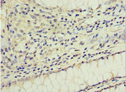 Immunohistochemistry of paraffin-embedded human colon cancer using CSB-PA009677ESR1HU at dilution of 1:100