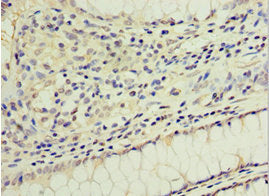 Immunohistochemistry of paraffin-embedded human colon cancer using CSB-PA009677ESR1HU at dilution of 1:100