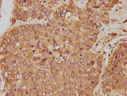IHC image of CSB-PA009679HA01HU diluted at 1:250 and staining in paraffin-embedded human liver cancer performed on a Leica BondTM system. After dewaxing and hydration, antigen retrieval was mediated by high pressure in a citrate buffer (pH 6.0). S...