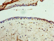 Immunohistochemistry of paraffin-embedded human breast cancer using CSB-PA009709HA01HU at dilution of 1:100