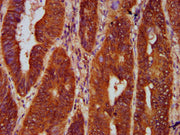 IHC image of CSB-PA009716LA01HU diluted at 1:300 and staining in paraffin-embedded human colon cancer performed on a Leica BondTM system. After dewaxing and hydration, antigen retrieval was mediated by high pressure in a citrate buffer (pH 6.0). S...