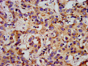 IHC image of CSB-PA009728LA01HU diluted at 1:300 and staining in paraffin-embedded human liver cancer performed on a Leica BondTM system. After dewaxing and hydration, antigen retrieval was mediated by high pressure in a citrate buffer (pH 6.0). S...