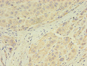 Immunohistochemistry of paraffin-embedded human liver cancer using CSB-PA009872LA01HU at dilution of 1:100