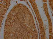 IHC image of CSB-PA009884LA01HU diluted at 1:200 and staining in paraffin-embedded human endometrial cancer performed on a Leica BondTM system. After dewaxing and hydration, antigen retrieval was mediated by high pressure in a citrate buffer (pH 6...