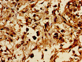 Immunohistochemistry of paraffin-embedded human melanoma using CSB-PA009887LA01HU at dilution of 1:100