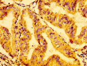IHC image of CSB-PA009888LA01HU diluted at 1:100 and staining in paraffin-embedded human cervical cancer performed on a Leica BondTM system. After dewaxing and hydration, antigen retrieval was mediated by high pressure in a citrate buffer (pH 6.0)...