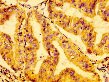 IHC image of CSB-PA009888LA01HU diluted at 1:100 and staining in paraffin-embedded human cervical cancer performed on a Leica BondTM system. After dewaxing and hydration, antigen retrieval was mediated by high pressure in a citrate buffer (pH 6.0)...