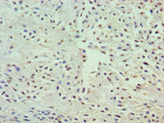 Immunohistochemistry of paraffin-embedded human breast cancer using CSB-PA009890ESR2HU at dilution of 1:100