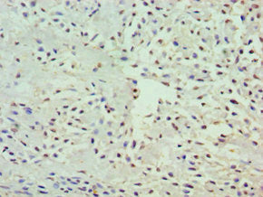 Immunohistochemistry of paraffin-embedded human breast cancer using CSB-PA009890ESR2HU at dilution of 1:100