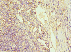 Immunohistochemistry of paraffin-embedded human colon cancer using CSB-PA009939ESR2HU at dilution of 1:100