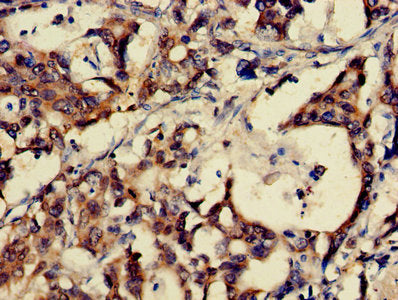 Immunohistochemistry of paraffin-embedded human gastric cancer using CSB-PA009940HA01HU at dilution of 1:100