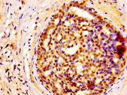 IHC image of CSB-PA009966LA01HU diluted at 1:400 and staining in paraffin-embedded human breast cancer performed on a Leica BondTM system. After dewaxing and hydration, antigen retrieval was mediated by high pressure in a citrate buffer (pH 6.0)....