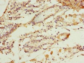 Immunohistochemistry of paraffin-embedded human gastric cancer using CSB-PA009994DSR2HU at dilution of 1:100